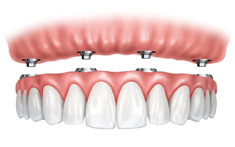 Hybrid Dentures | St. George Family Dental | Fulton MO